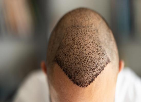 Thinking of a hair transplant? Here's where many Americans are heading.