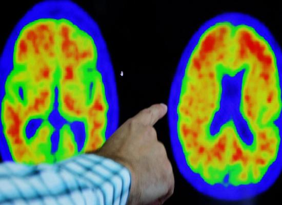 New drug found to slow Alzheimer's